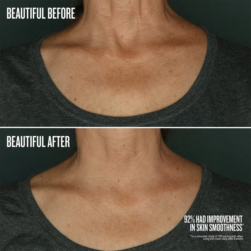 Before and after comparison of neck skin smoothness with text indicating improvement.