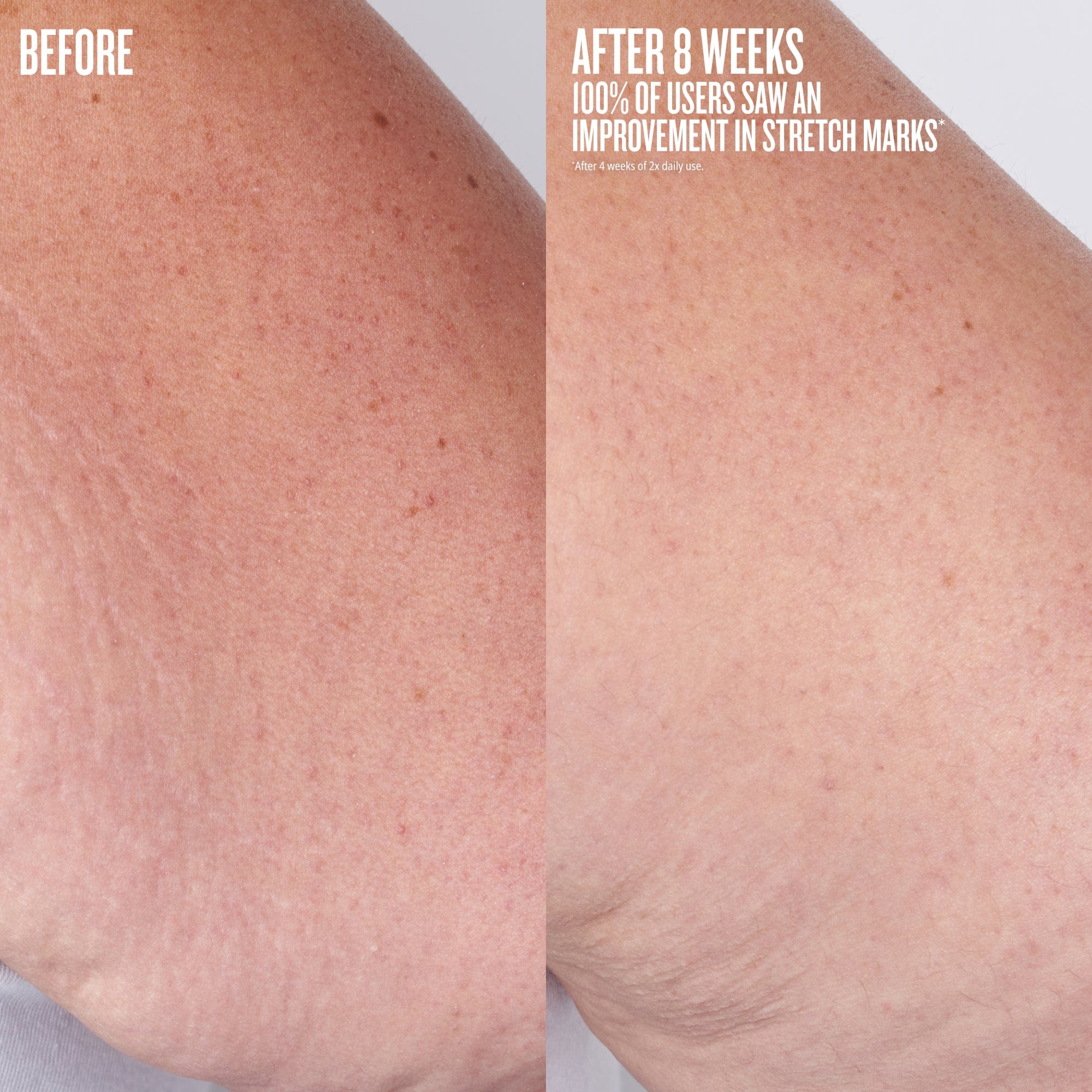 before after 8 weeks 100% of users save an improvement in stretchmarks* *after 4 weeks of 2x daily use
